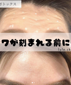 ルラ 額ボトックス
