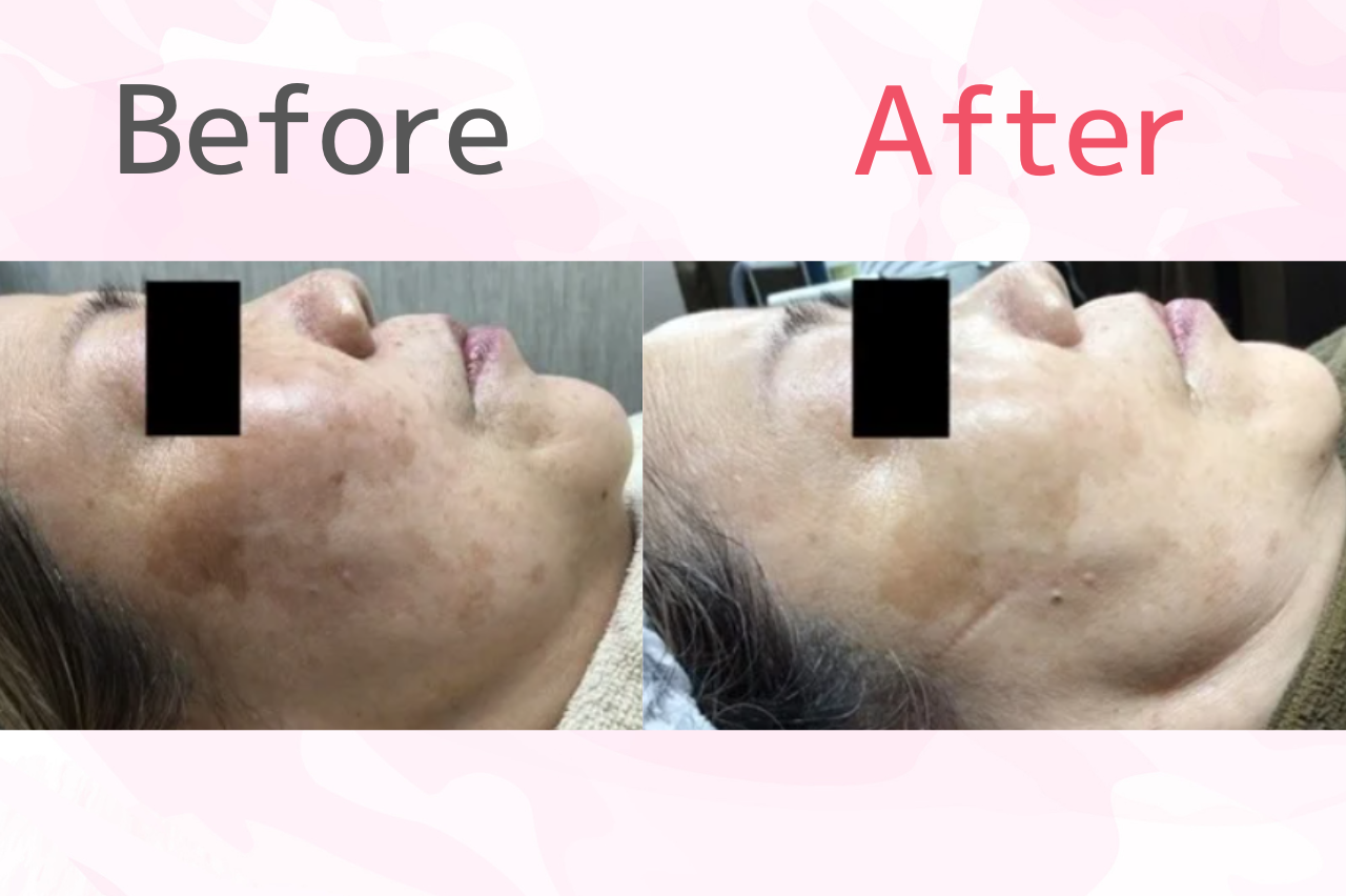 銀座よしえクリニック　シミ取り