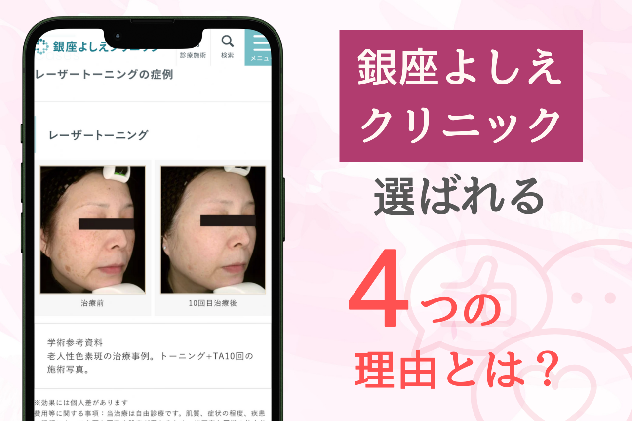 銀座よしえクリニックのシミ取り治療が人気な理由とは？