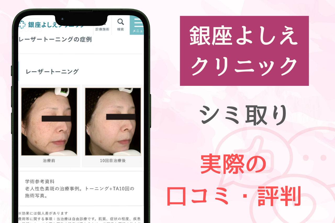 銀座よしえクリニックのシミ取り治療の口コミ・評判【実際の利用者の声】
