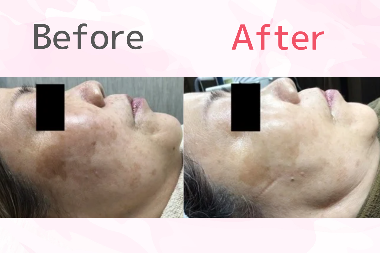 「フォトフェイシャルM22で肌全体のトーンアップが実感できた」という口コミ