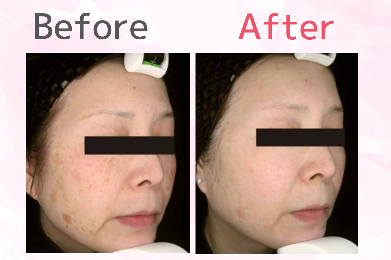 「ピコレーザー（シミ取りスポット）で効果を実感した」という評判