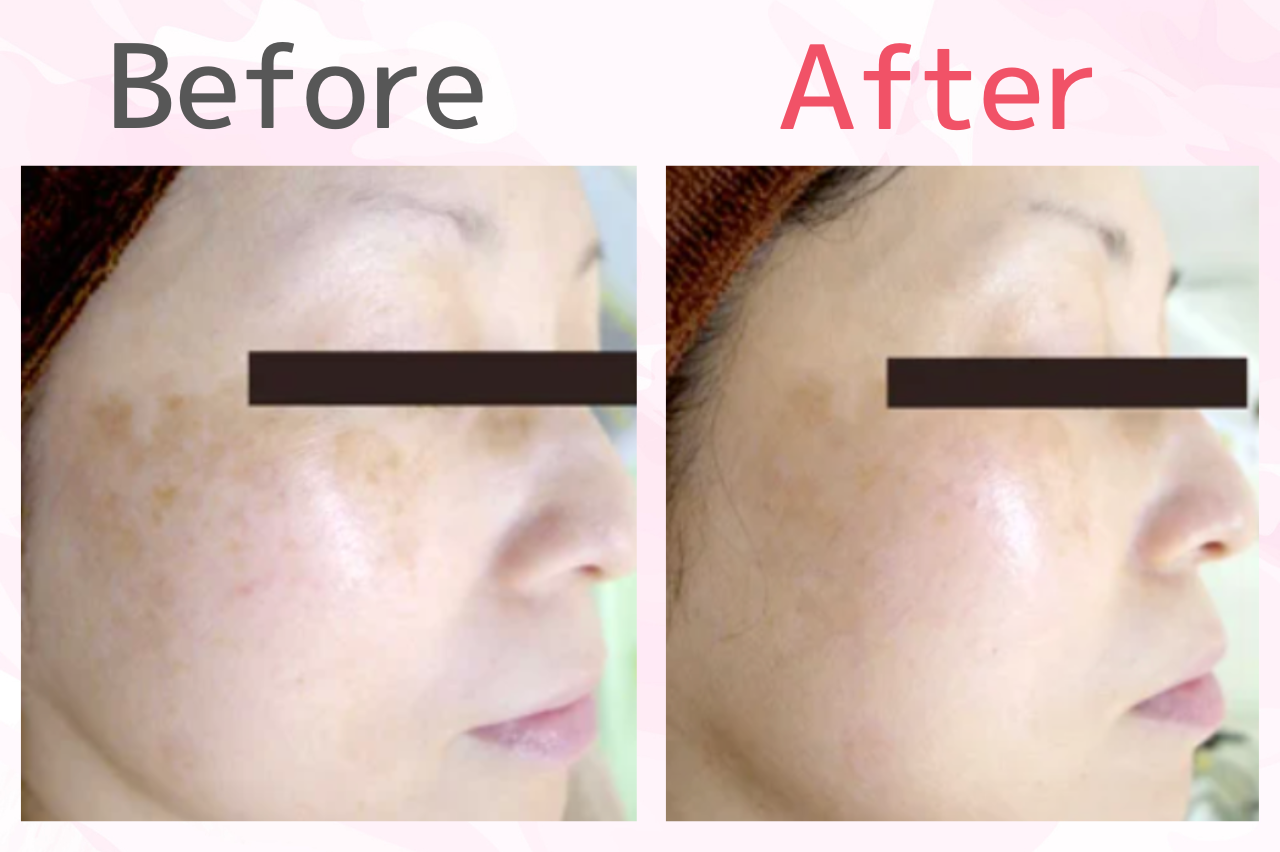 銀座よしえクリニック　シミ取り