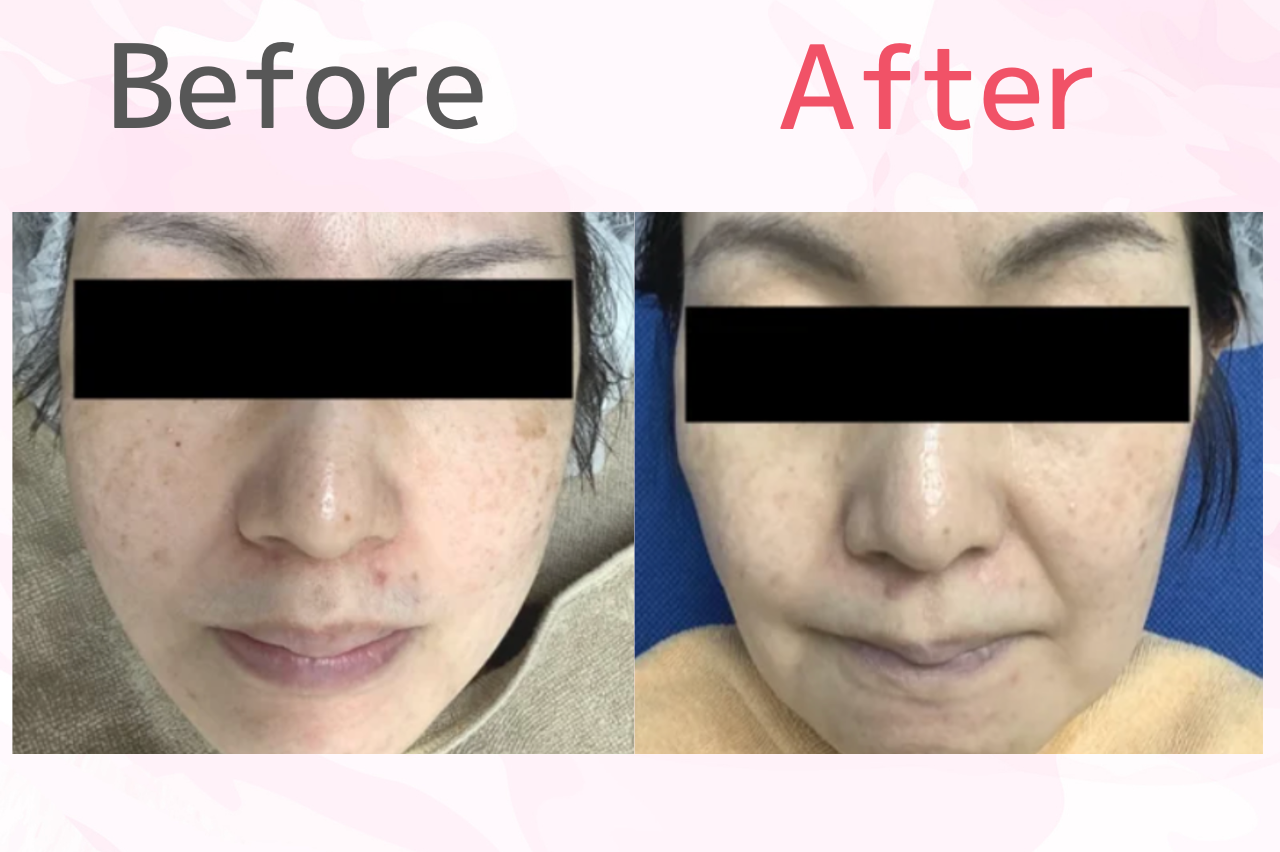 銀座よしえクリニック　シミ取り