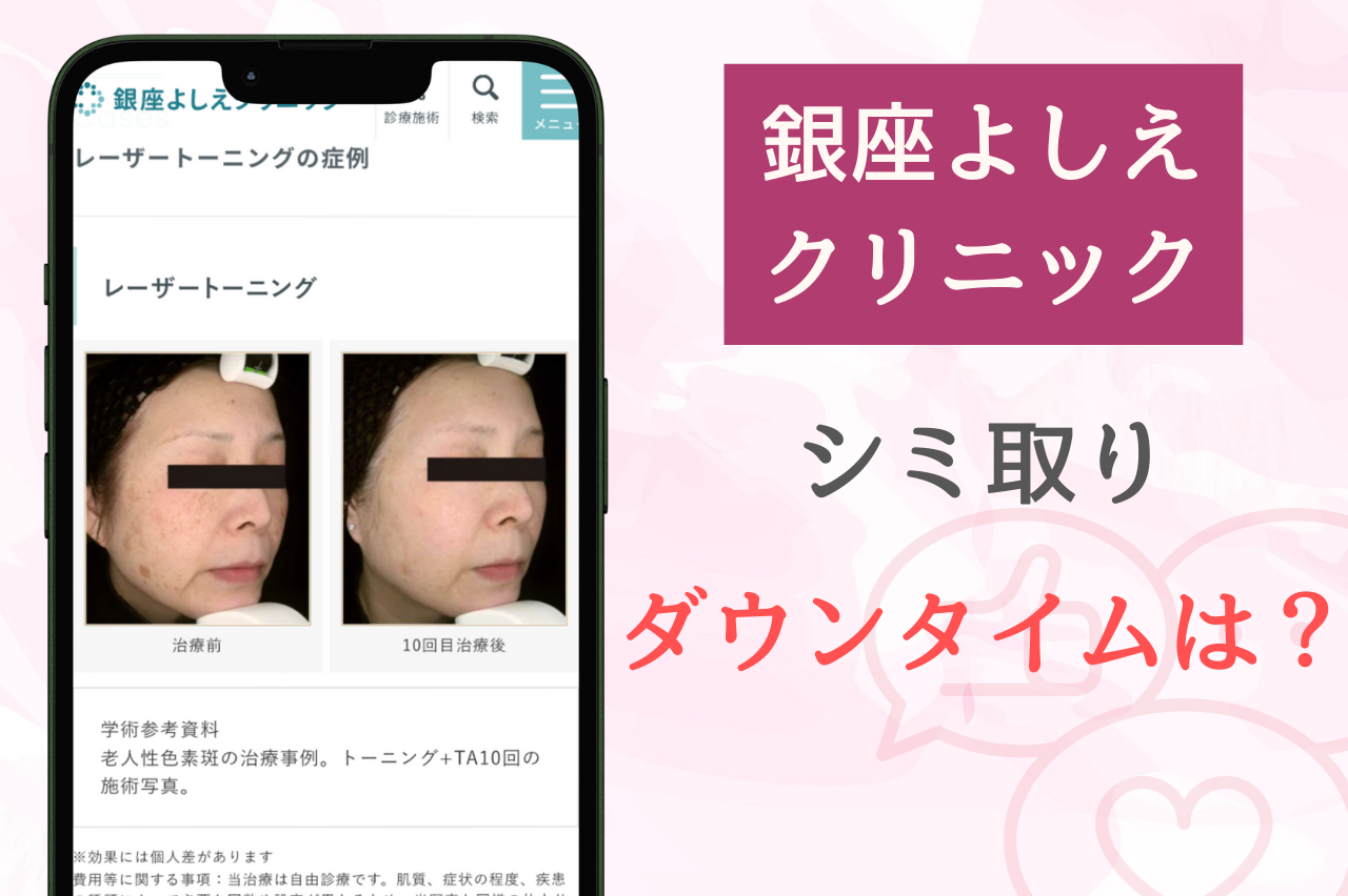 銀座よしえクリニックのシミ取りのダウンタイムは？