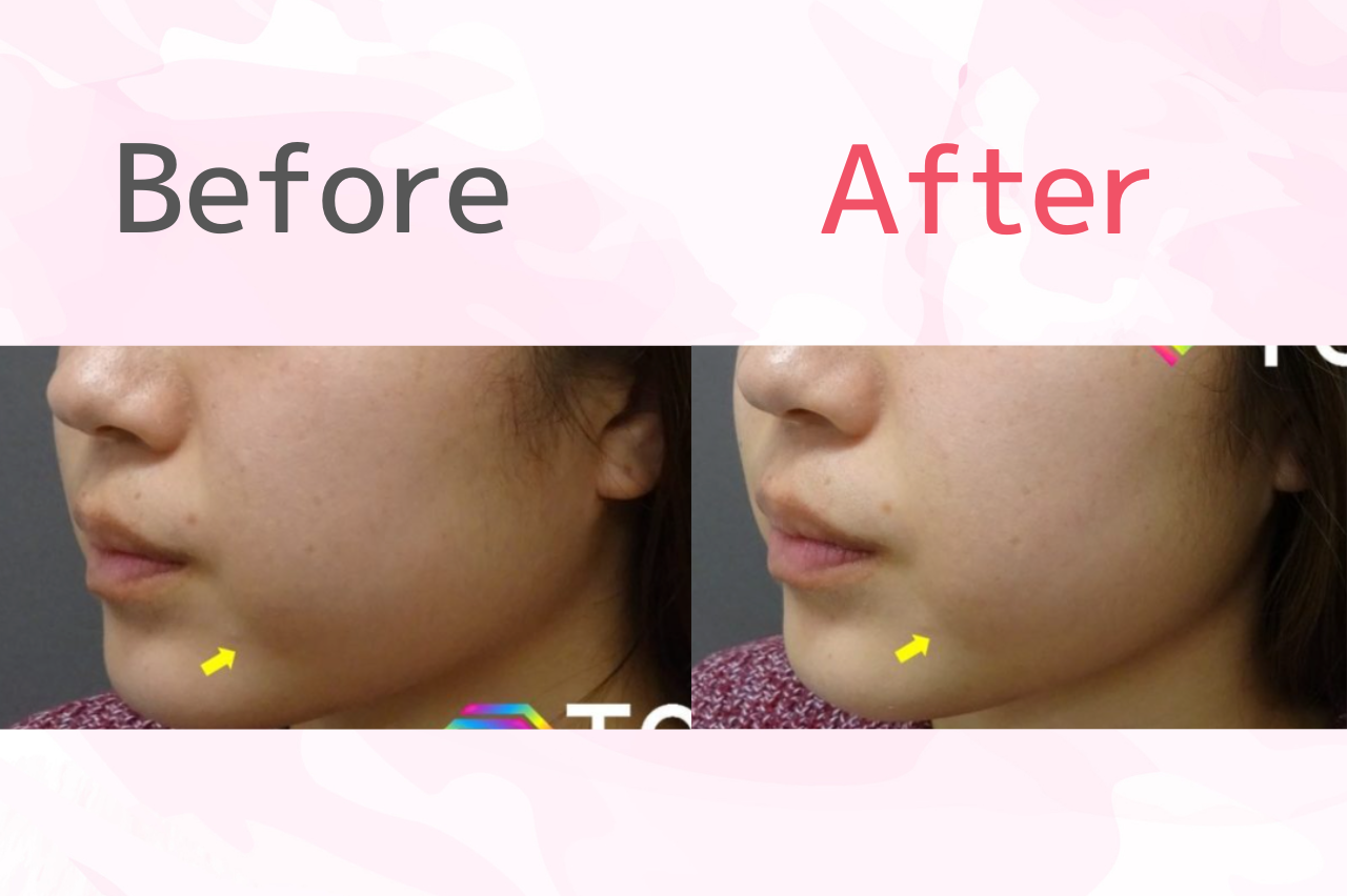 頬のたるみが引き締まった症例