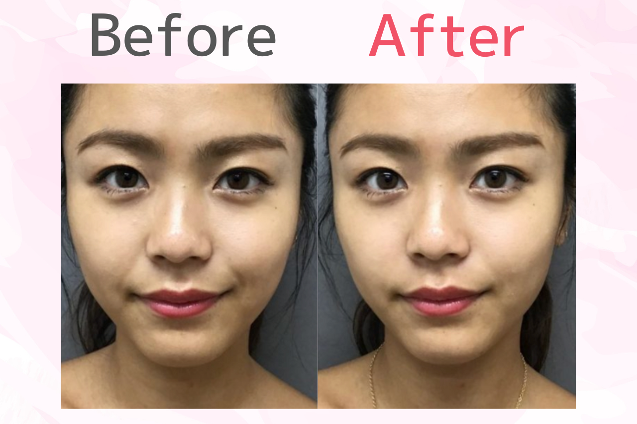 ほうれい線が薄くなった症例