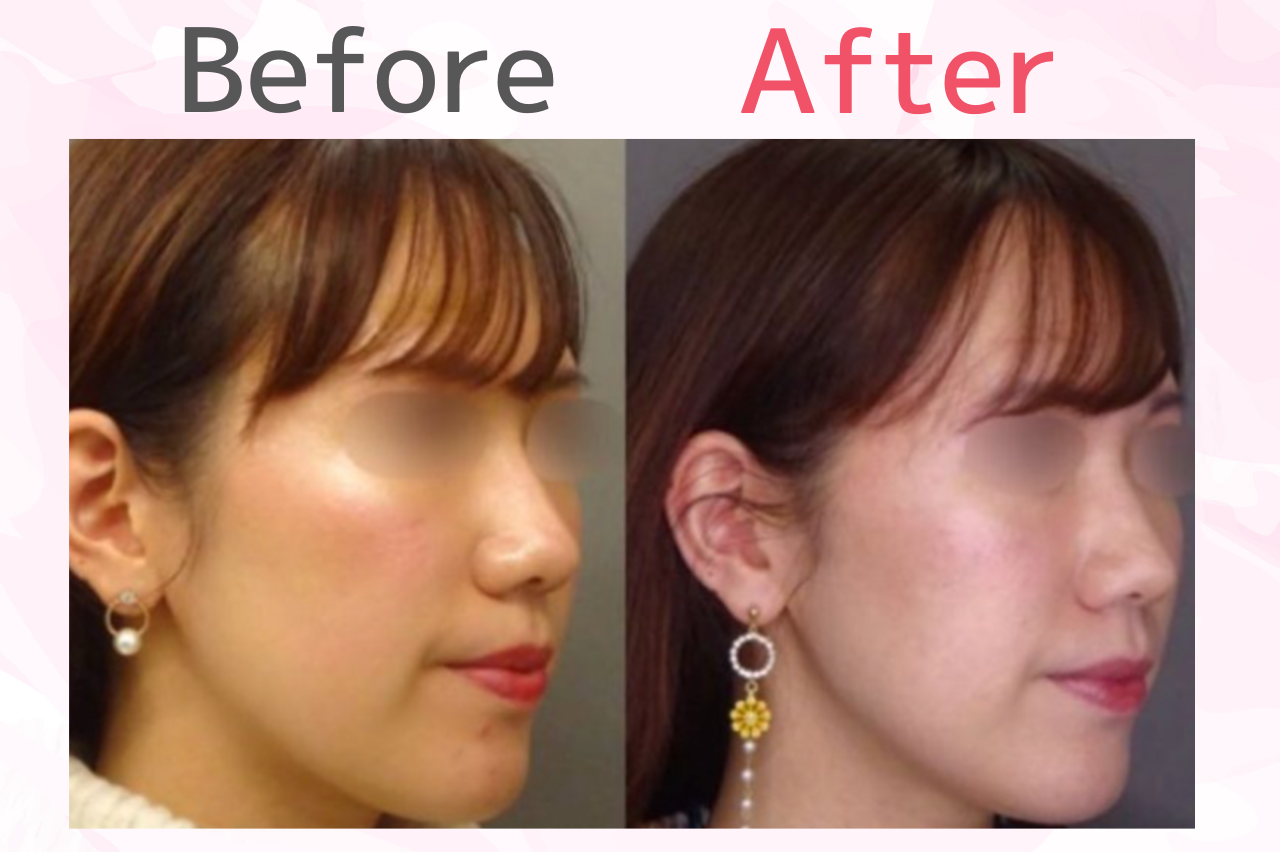 フェイスラインがシャープになった症例